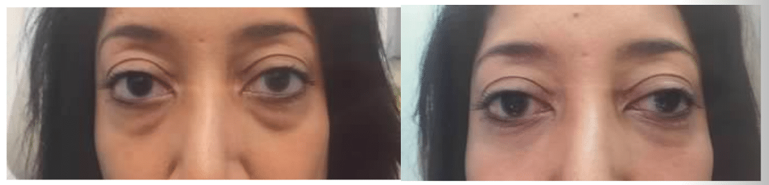 belotero before and after under eyes