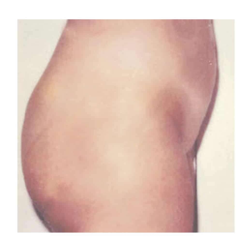 16343 Liposuction After