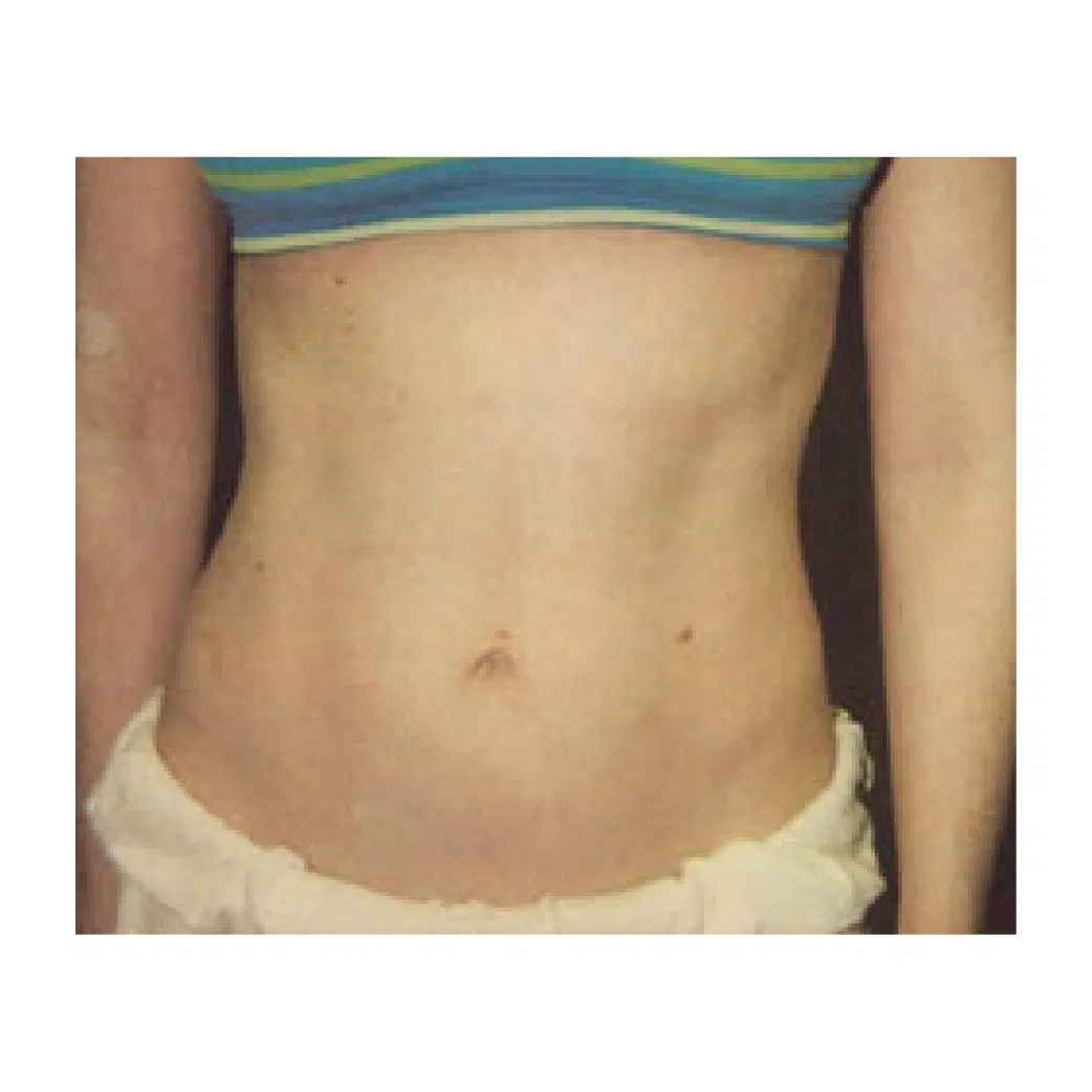 43856 Liposuction After