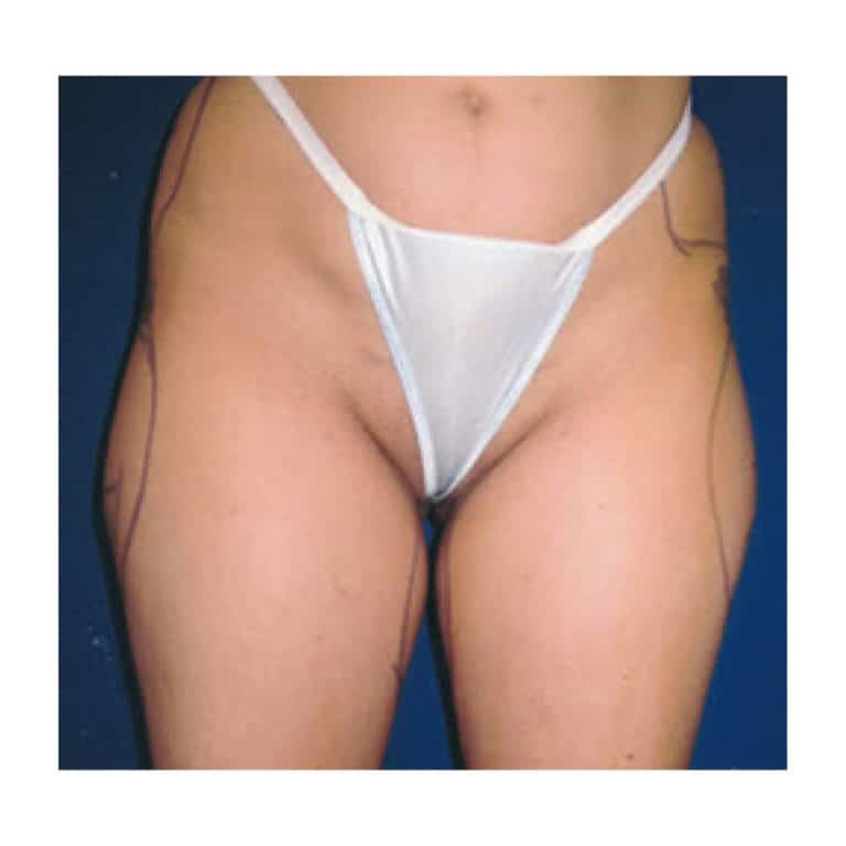 61352 Liposuction Before