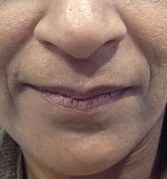 70863 Restylane Before