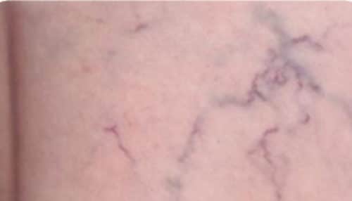 Before Leg veins treatment 2