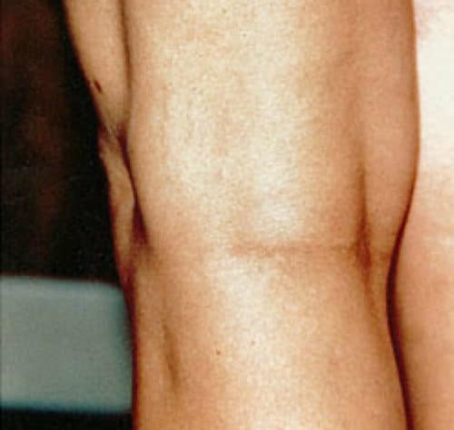 After Leg veins treatment