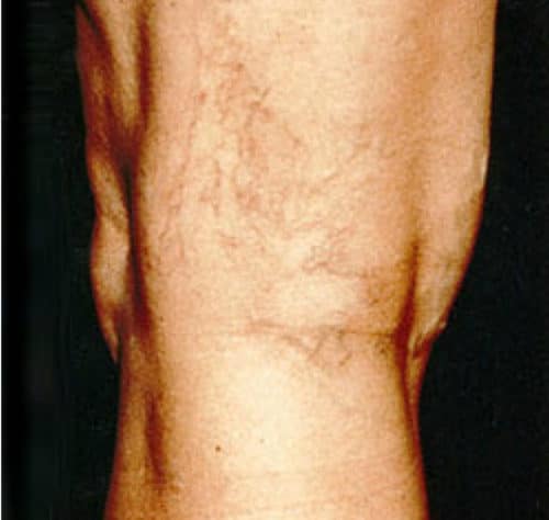 Before Leg veins treatment