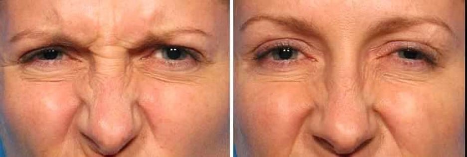 york skin treatment Pictures & Results After Before Injections  in Botox