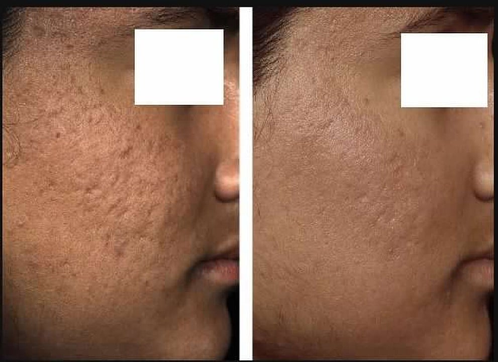 Fraxel Acne Scars