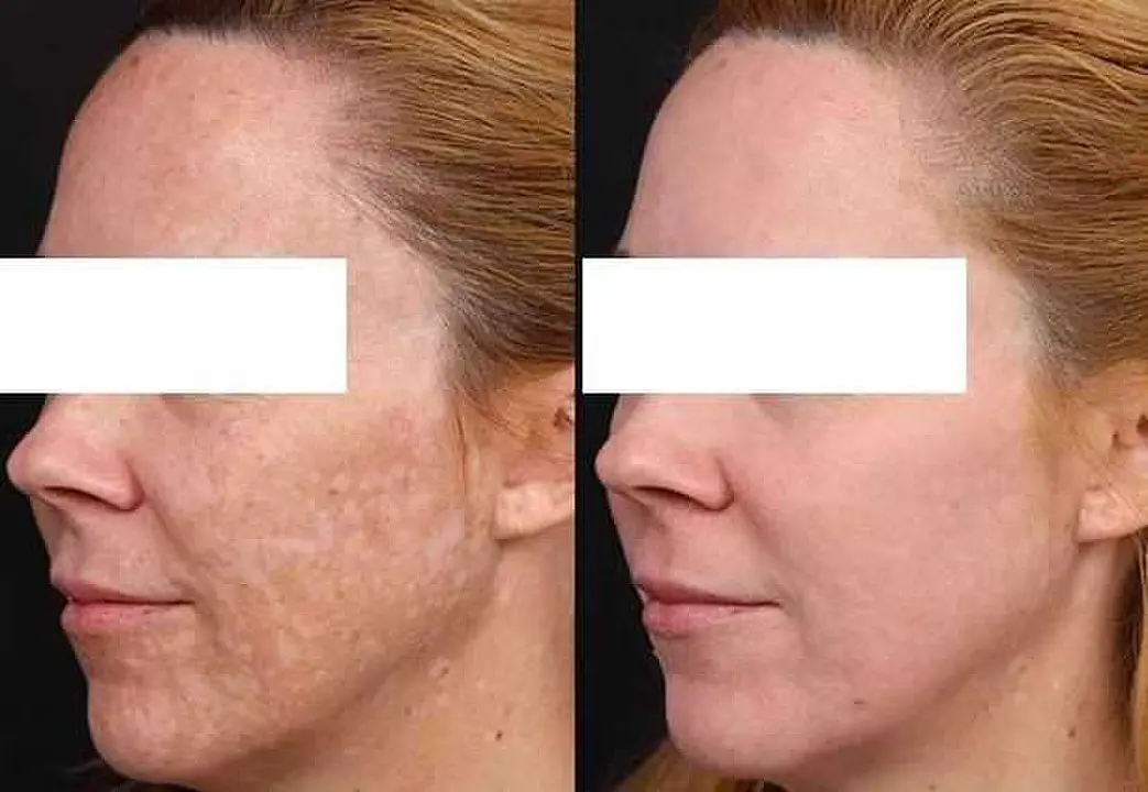 Melasma 3