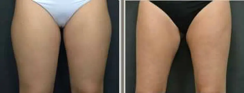 Sculpsure Thighs