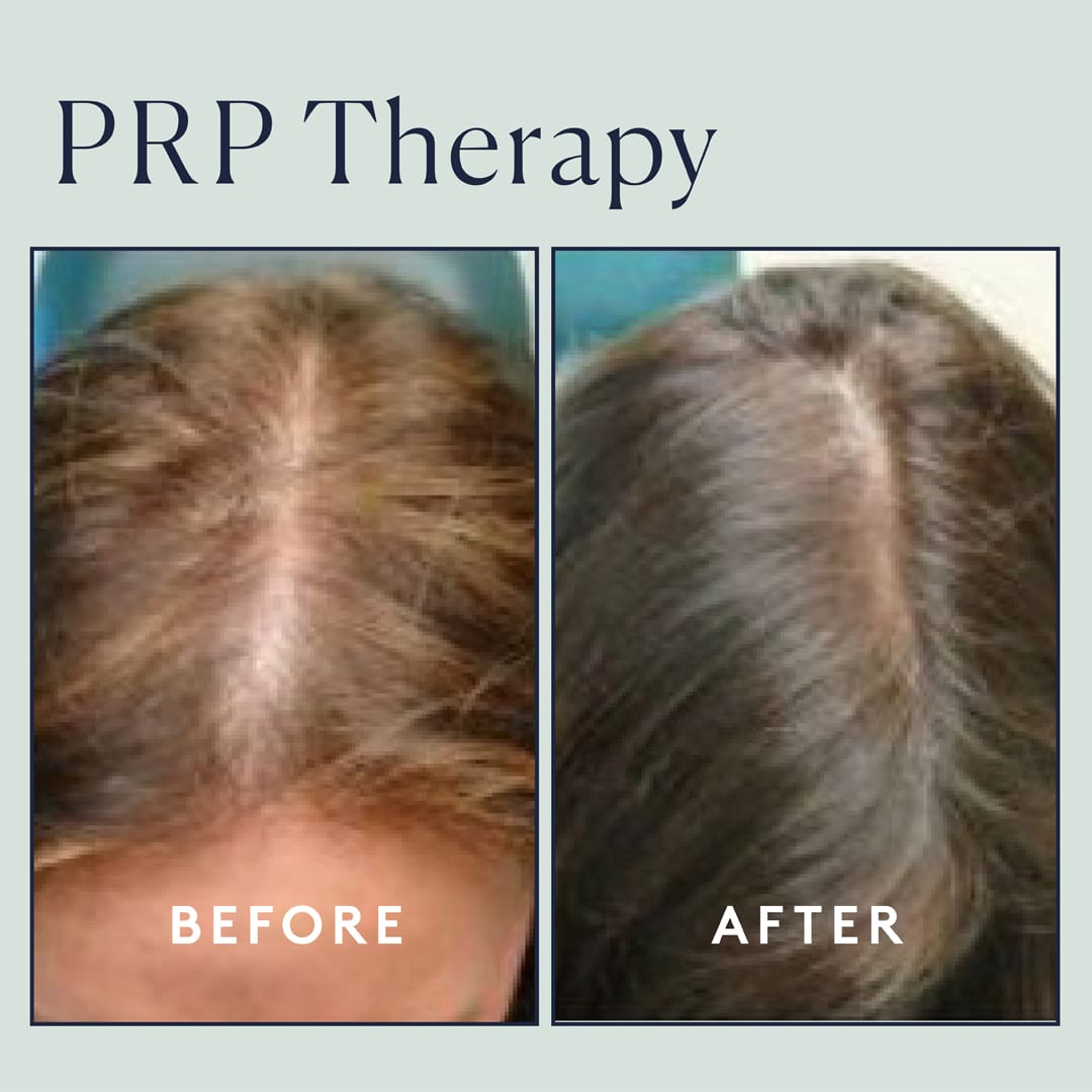 Regenerate Hair Growth Naturally with PRP Therapy in NYC - Sobel Skin