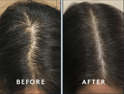 PRP Therapy hair loss before and after