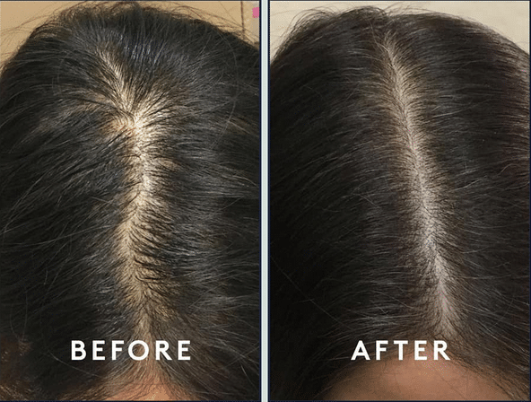 Are You Suffering from Hair Loss? - PRP Therapy in NYC - Sobel Skin