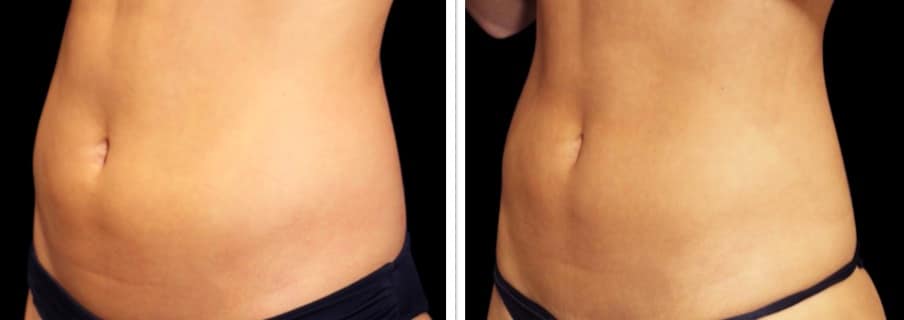 Abdomen Woman Before And After 3