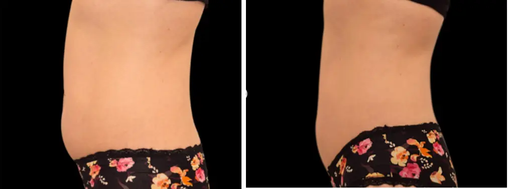 Emsculpt Woman Abdomen Before And After 1