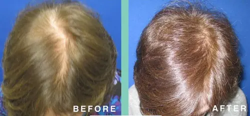 Prp Therapy Before And After Image2 500x232