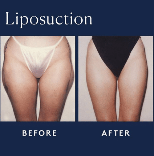 lipo -hips and outer thighs 