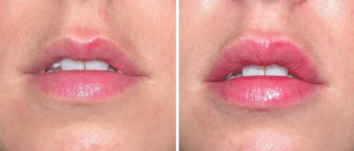 the-difference-between-restylane-refyne-defyne-lyft-silk-lips