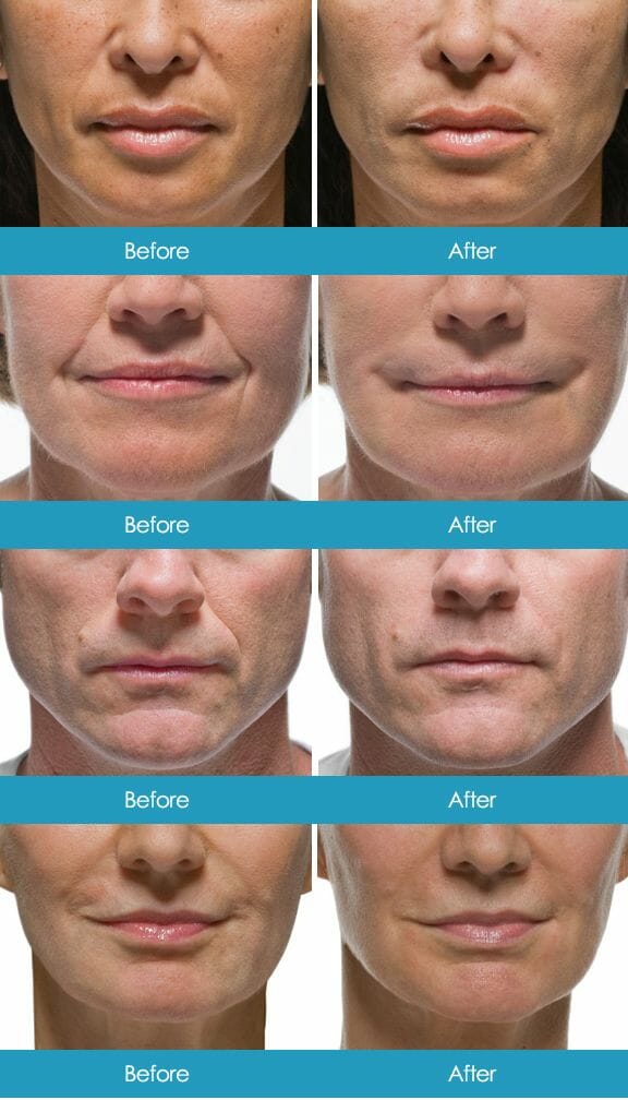 Before & After Pictures of Radiesse Treatments - Sobel Skin