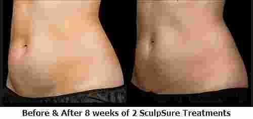 sculpsure - before and 8 weeks after 2 treatments nyc