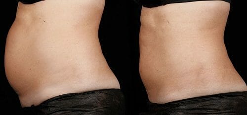 sculpsure body contouring manhattan