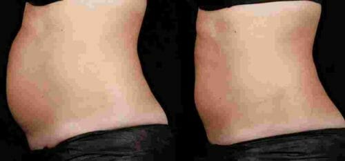 sculpsure body contouring nyc