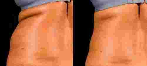 sculpsure nyc