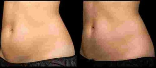 sculpsure body contouring nyc