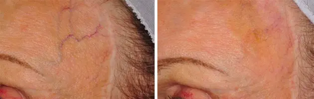 Cutera Forehead Veins Case 12