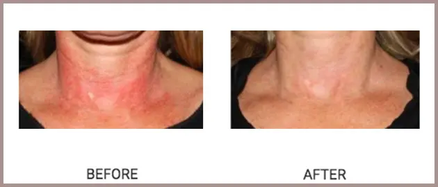 Cutera Rosacea Case 16