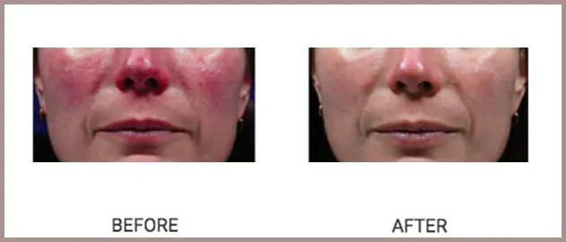 Cutera Rosacea Case 19 Ba