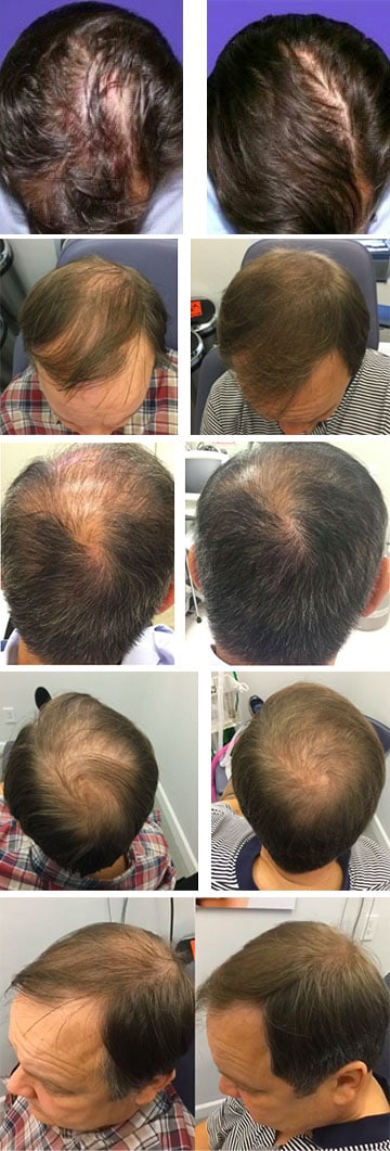 PRP for Hair Loss NYC | PRP Hair Restoration NYC | Sobel Skin