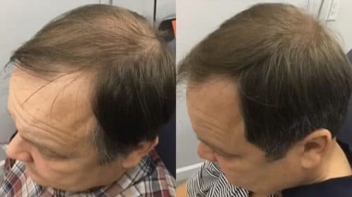 PRP Treatment Case 5