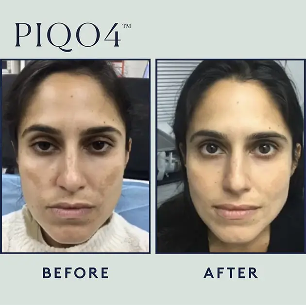 Piqo Melasma Case 1