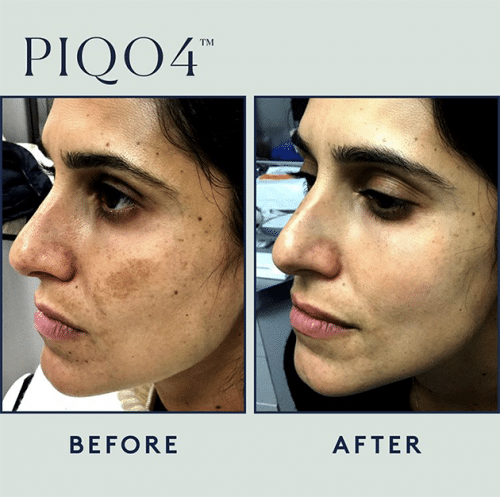 Piqo Melasma Case 2