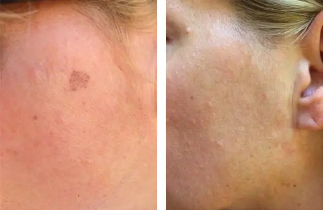 Piqo Spot Treatment Case 1