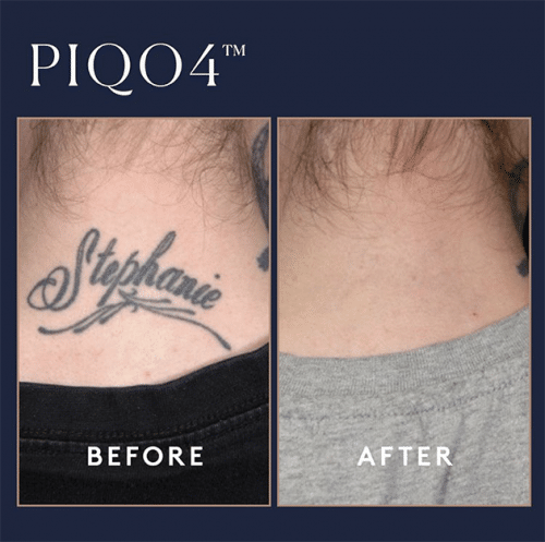 Piqo Tattoo Removal