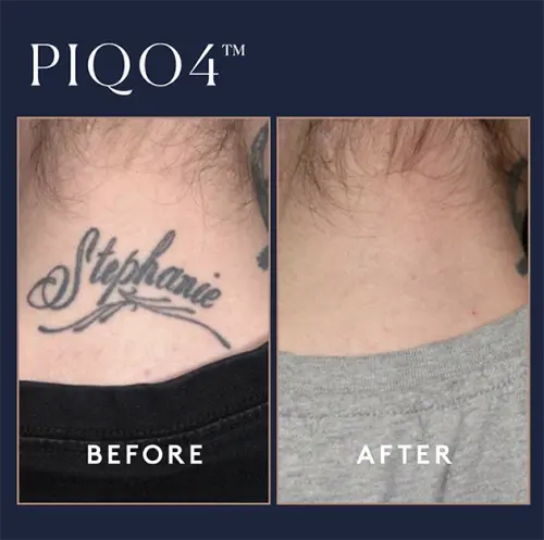 Piqo Tattoo Case 1