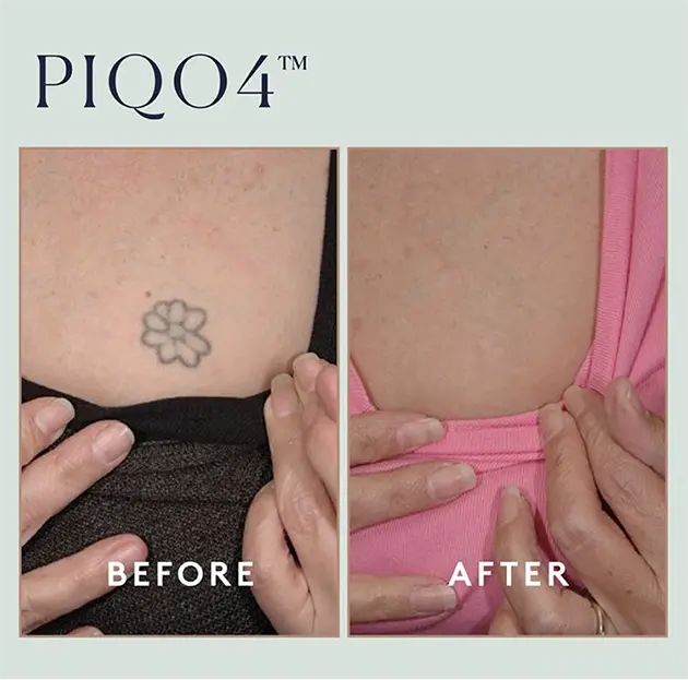 Piqo Tattoo Case 2