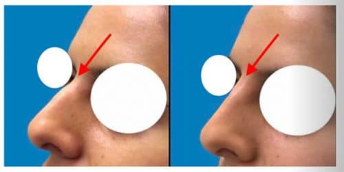 Silicone Nose Case 1