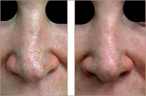 Silicone Nose Case 2