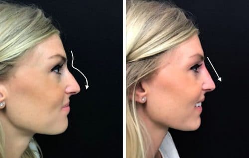 Silicone Nose Case 3 Right View