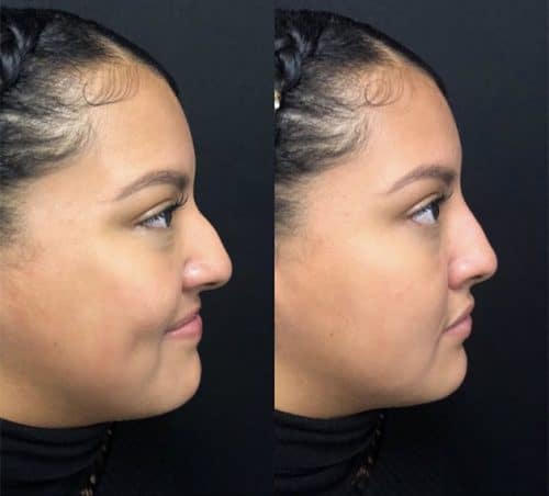 Silicone Nose Case 4