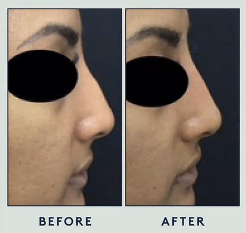 Silicone Nose Case 5