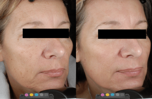 CO2 Laser Skin Resurfacing