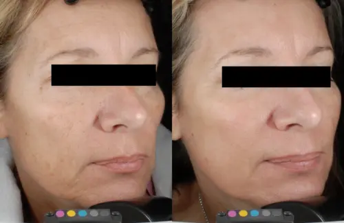 Tetra CO2 CoolPeel Laser Treatment in NYC - Sobel Skin