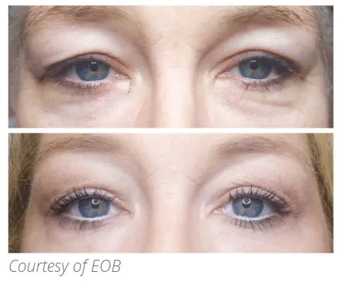 Eob Eyes
