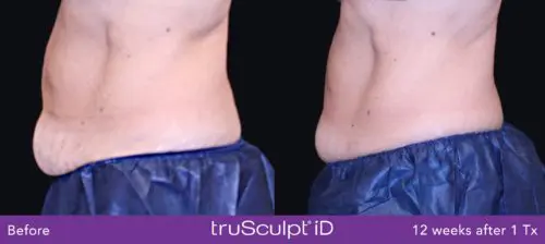 Trusculpt Man 500x224 1