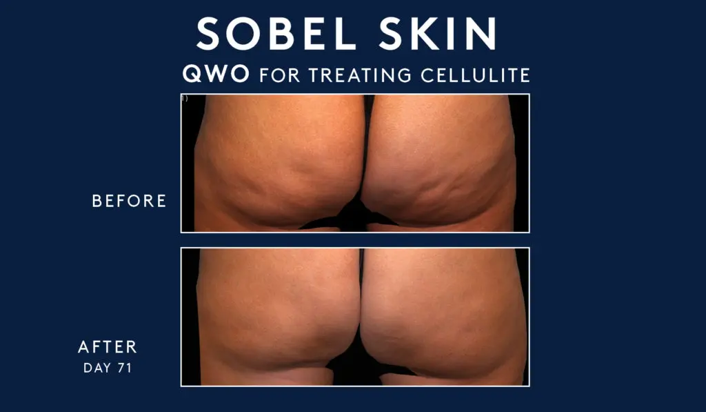 QWO Cellulite Treatments in NYC - Dr. Howard Sobel, MD